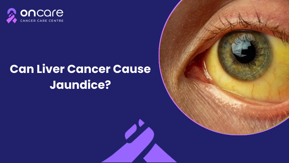 can-liver-cancer-cause-jaundice-yellow-eyes-and-skin-explained